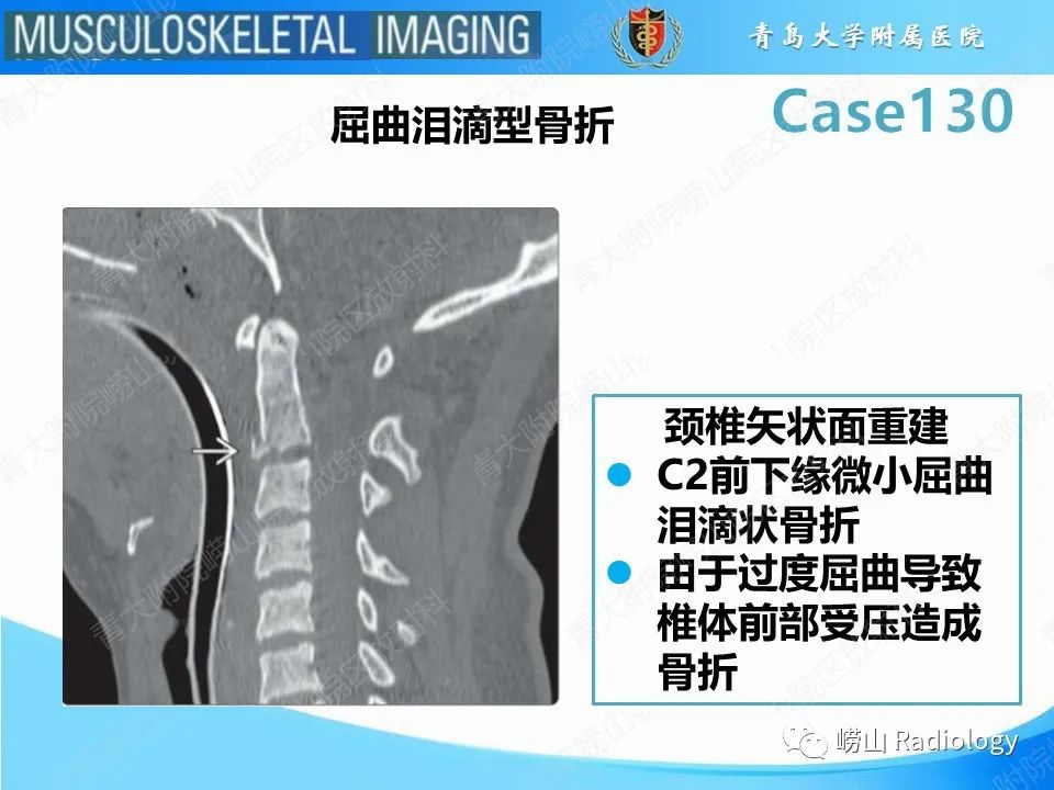 影像PPT - 【PPT】C2过伸骨折-16