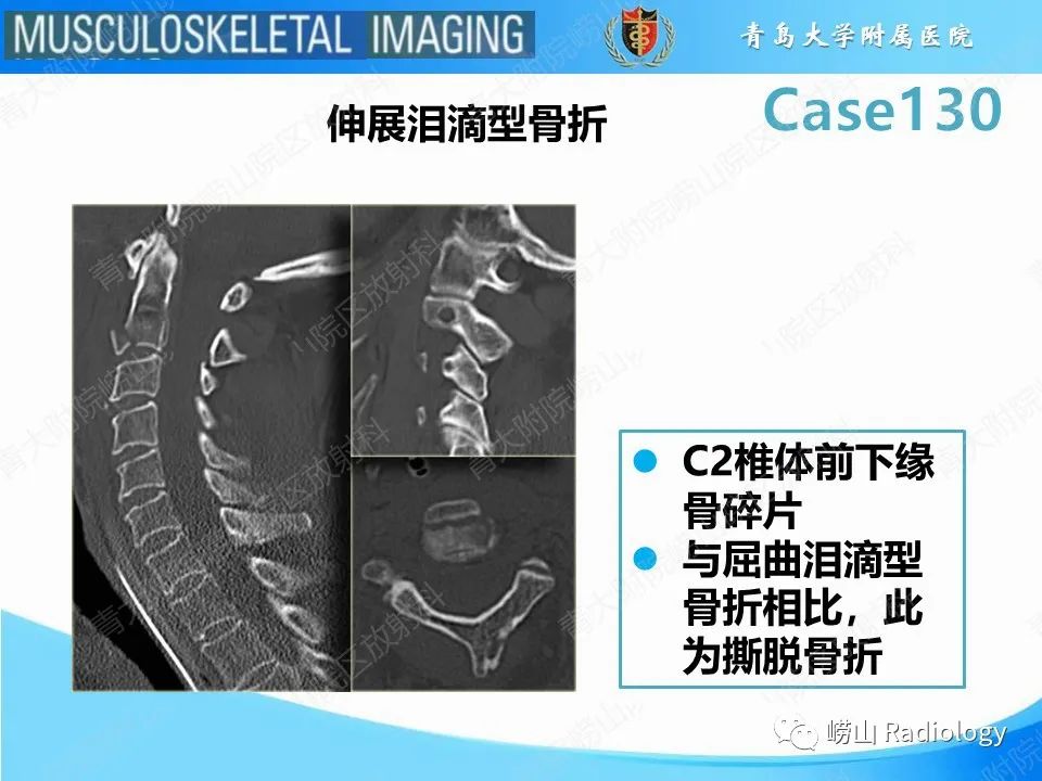 影像PPT - 【PPT】C2过伸骨折-15