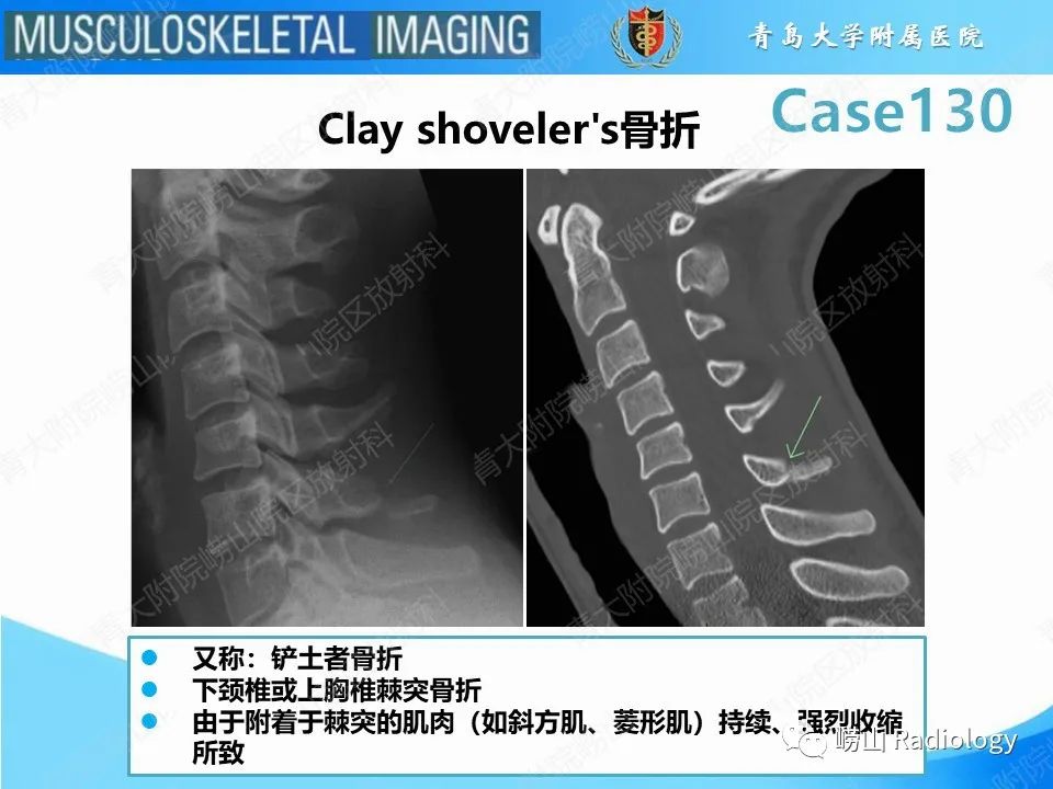 影像PPT - 【PPT】C2过伸骨折-19