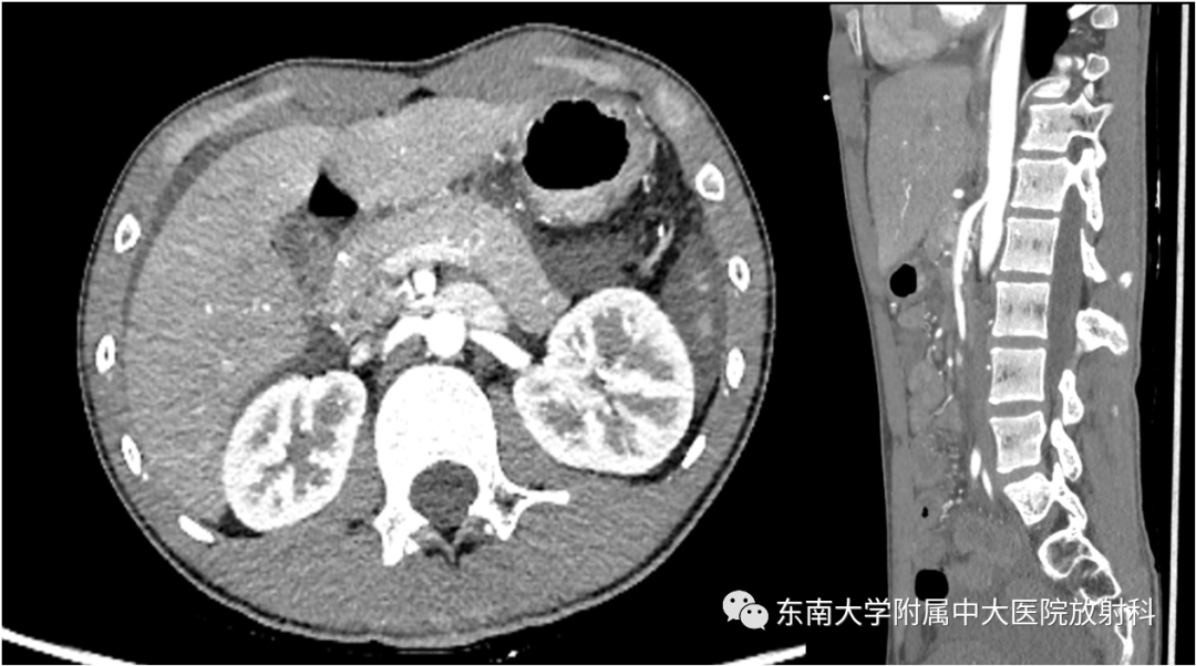 影像PPT - 【PPT】胡桃夹综合征-1