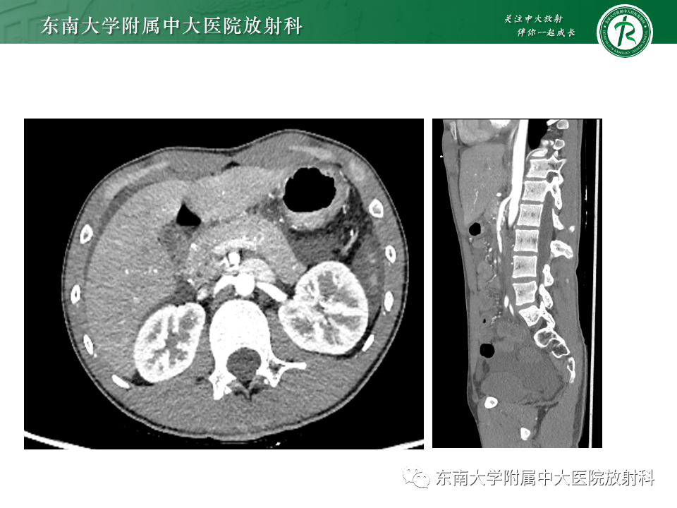 影像PPT - 【PPT】胡桃夹综合征-3