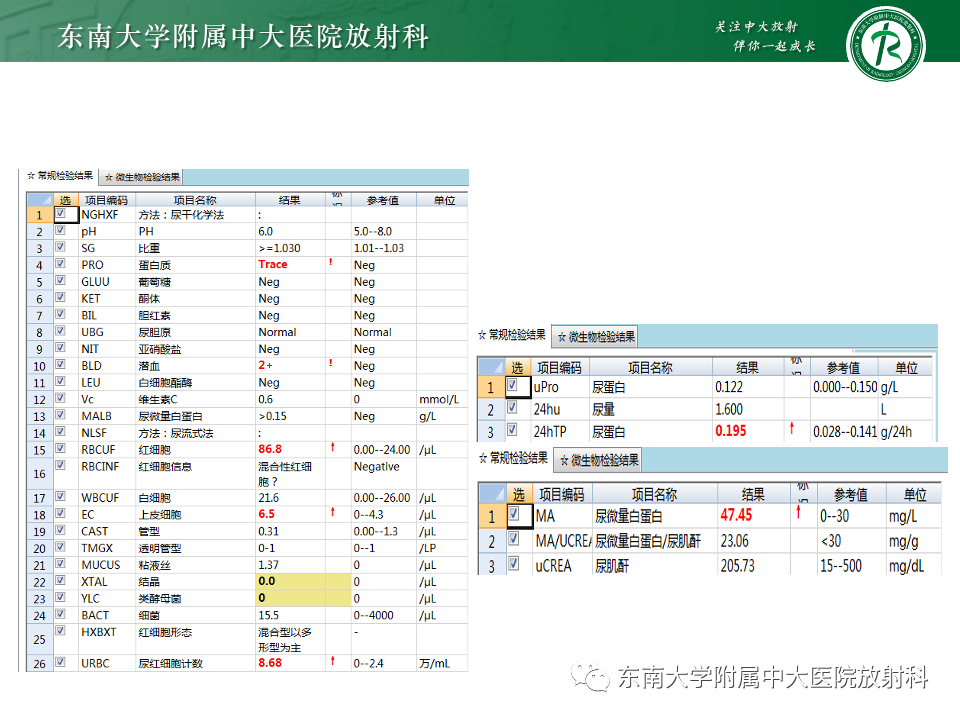影像PPT - 【PPT】胡桃夹综合征-4