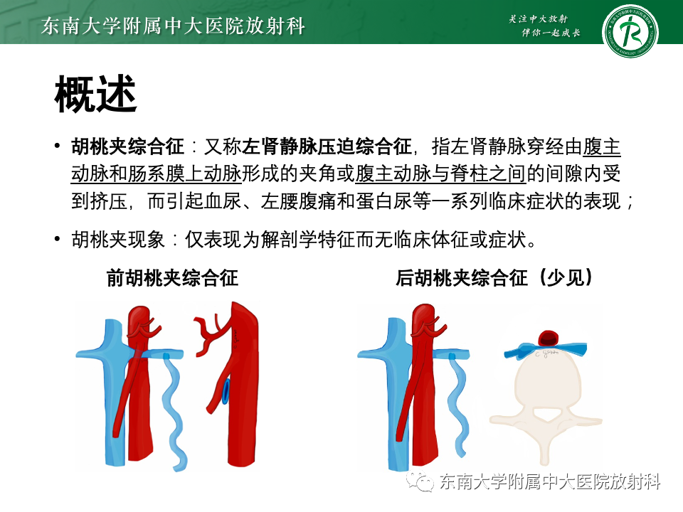 影像PPT - 【PPT】胡桃夹综合征-7