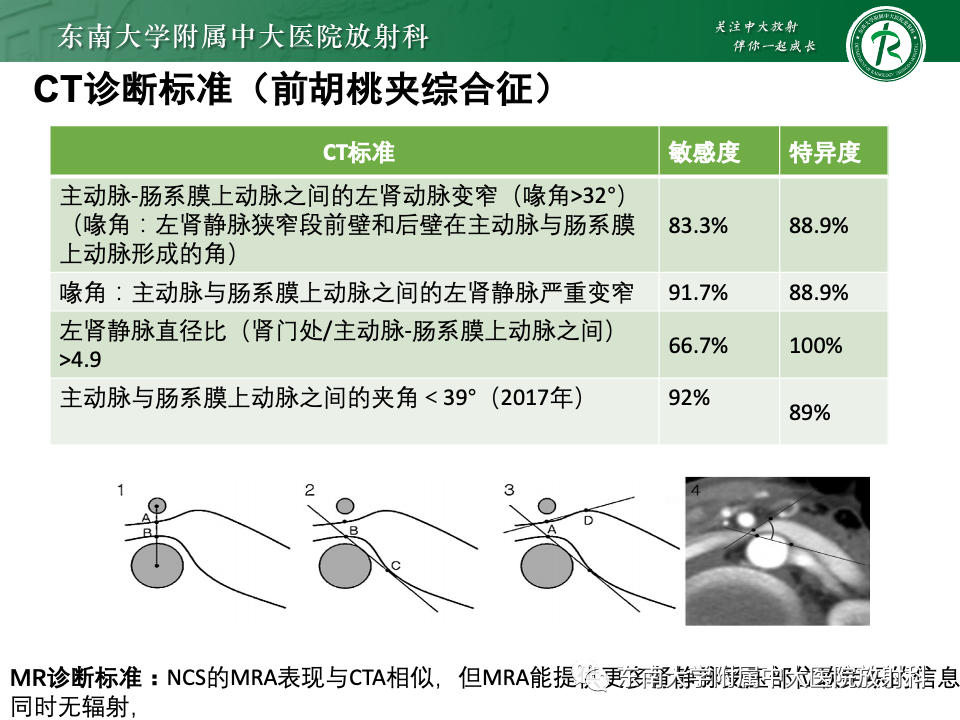 影像PPT - 【PPT】胡桃夹综合征-11