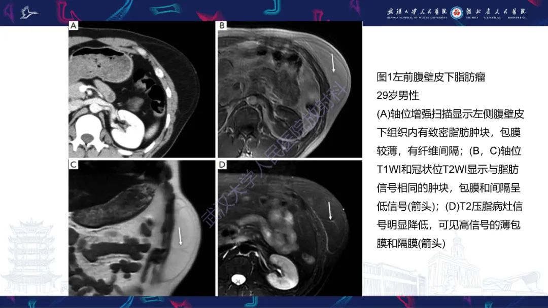 影像PPT - 【PPT】腹壁肿瘤及肿瘤样病变影像诊断-9
