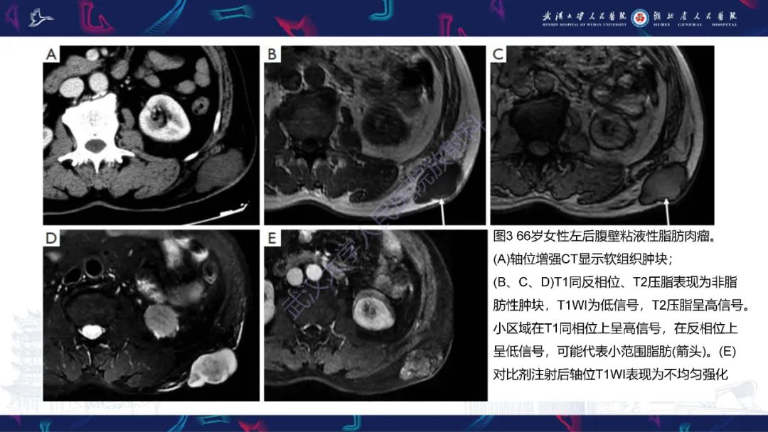 影像PPT - 【PPT】腹壁肿瘤及肿瘤样病变影像诊断-12
