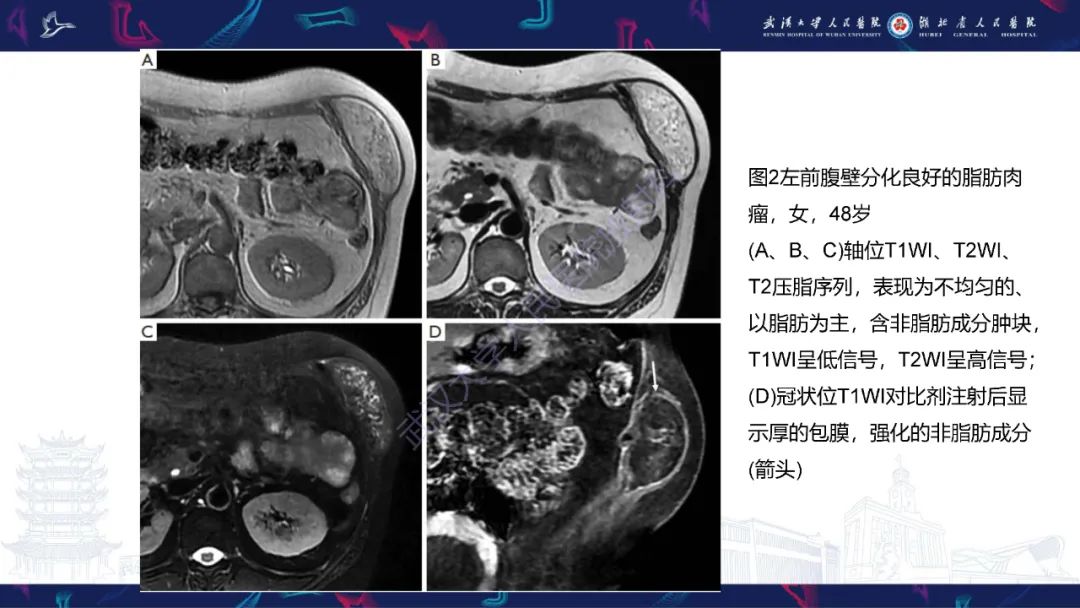 影像PPT - 【PPT】腹壁肿瘤及肿瘤样病变影像诊断-11