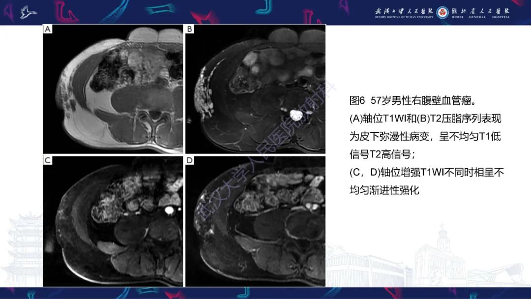影像PPT - 【PPT】腹壁肿瘤及肿瘤样病变影像诊断-22
