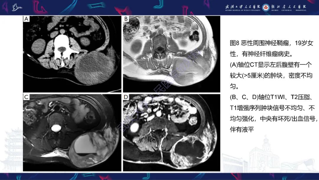 影像PPT - 【PPT】腹壁肿瘤及肿瘤样病变影像诊断-27