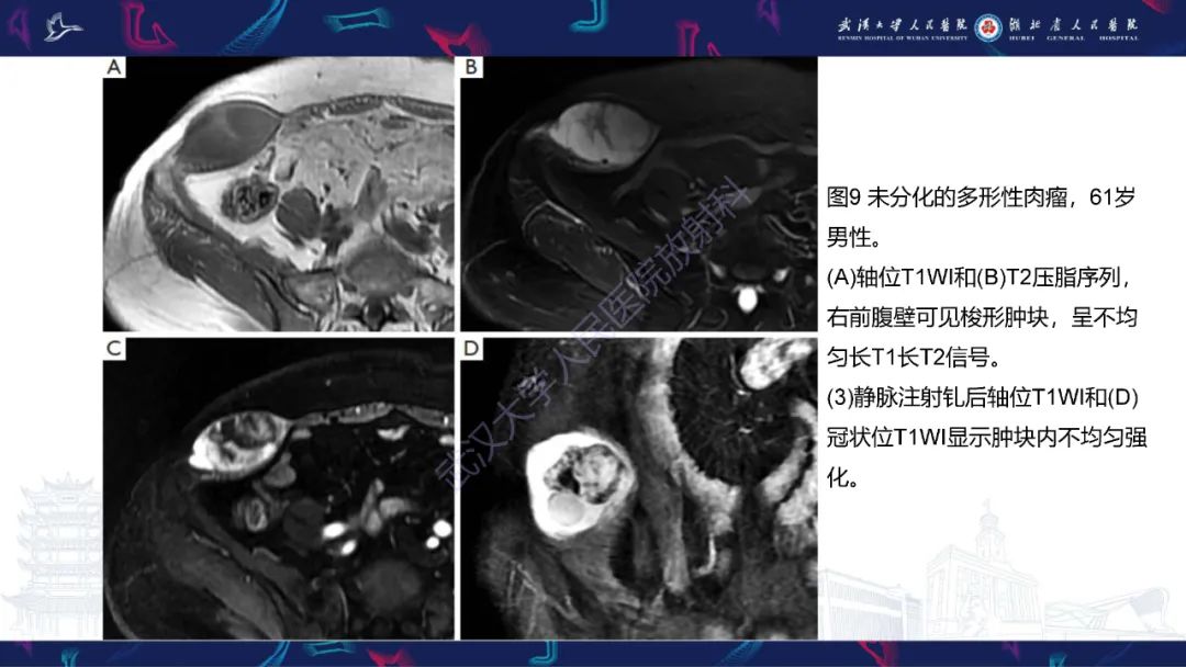影像PPT - 【PPT】腹壁肿瘤及肿瘤样病变影像诊断-30