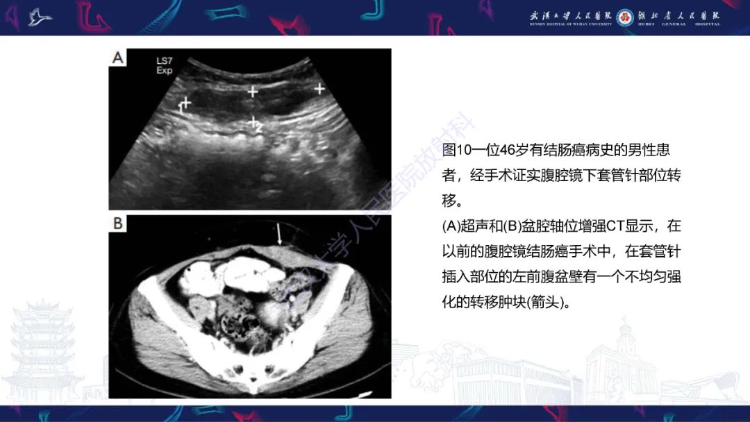 影像PPT - 【PPT】腹壁肿瘤及肿瘤样病变影像诊断-33