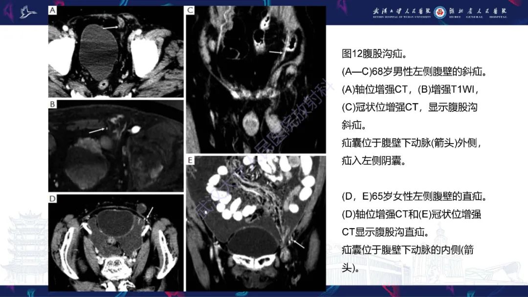 影像PPT - 【PPT】腹壁肿瘤及肿瘤样病变影像诊断-39