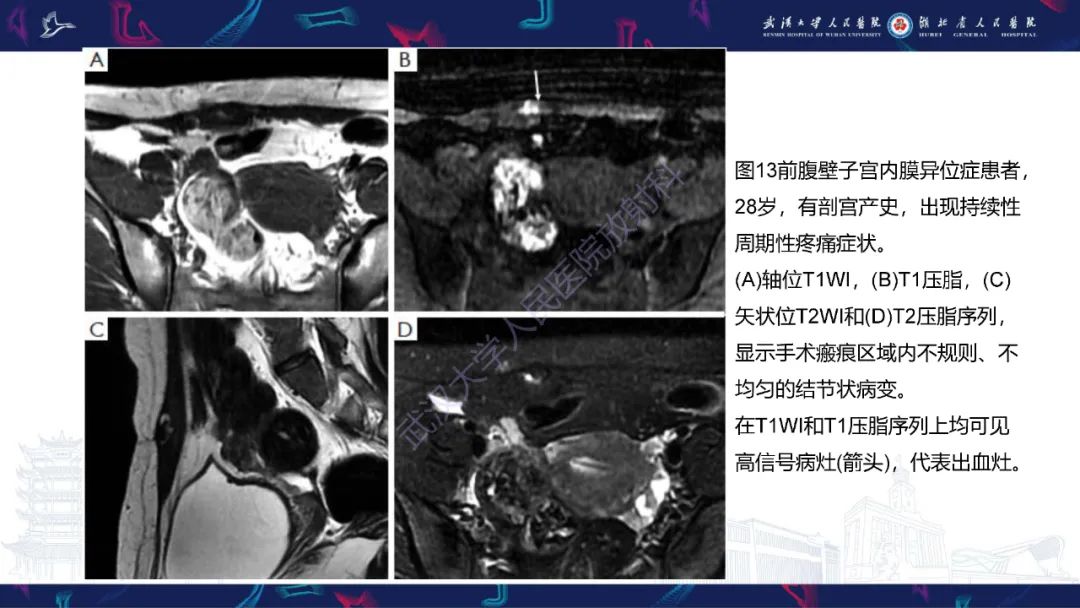 影像PPT - 【PPT】腹壁肿瘤及肿瘤样病变影像诊断-42