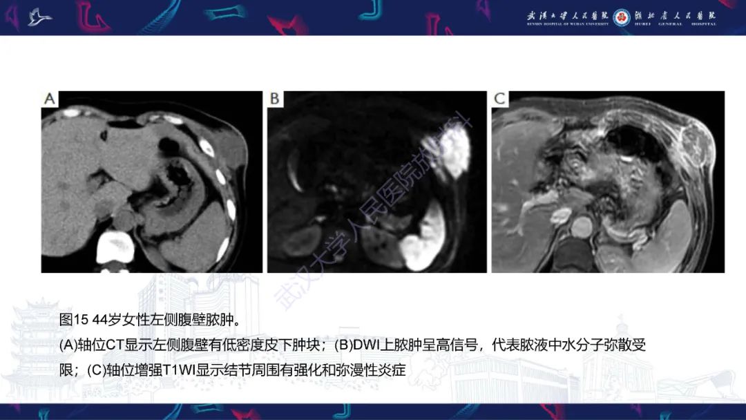 影像PPT - 【PPT】腹壁肿瘤及肿瘤样病变影像诊断-46