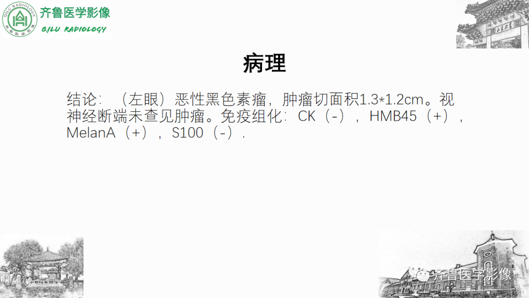 影像PPT - 【PPT】眼与眼眶病变—脉络膜黑色素瘤-5