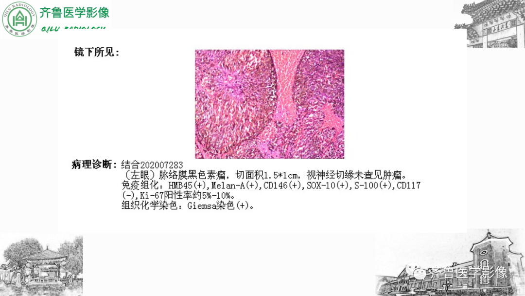 影像PPT - 【PPT】眼与眼眶病变—脉络膜黑色素瘤-8