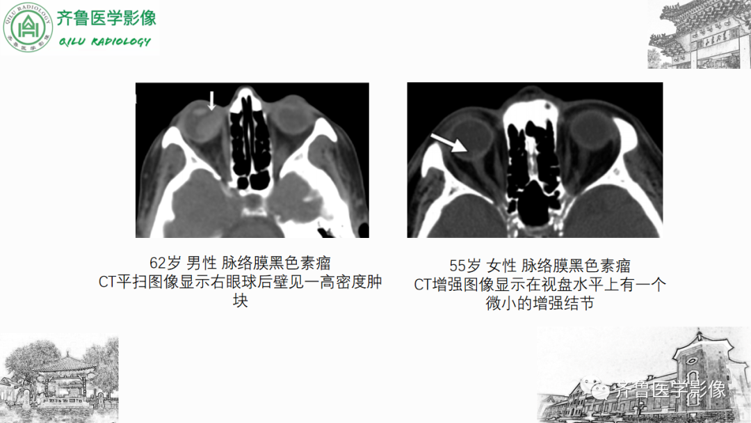 影像PPT - 【PPT】眼与眼眶病变—脉络膜黑色素瘤-18