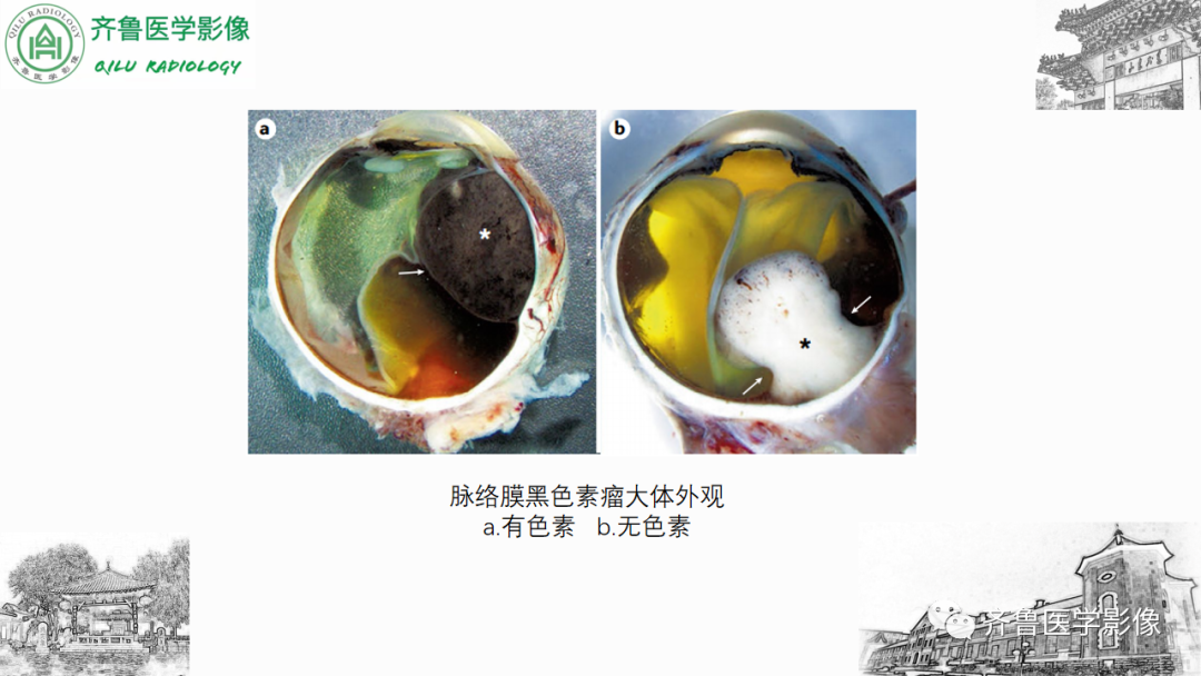 影像PPT - 【PPT】眼与眼眶病变—脉络膜黑色素瘤-15