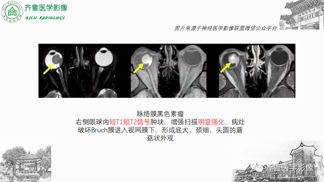 影像PPT - 【PPT】眼与眼眶病变—脉络膜黑色素瘤-20