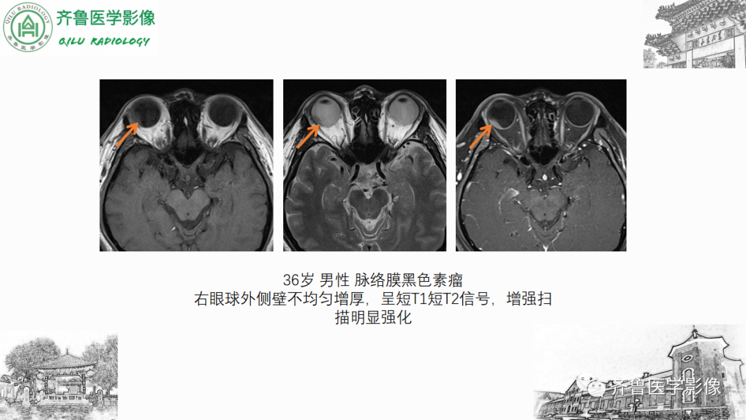 影像PPT - 【PPT】眼与眼眶病变—脉络膜黑色素瘤-21