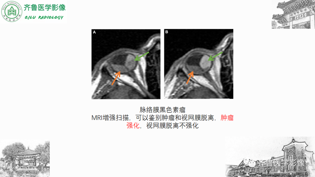 影像PPT - 【PPT】眼与眼眶病变—脉络膜黑色素瘤-22