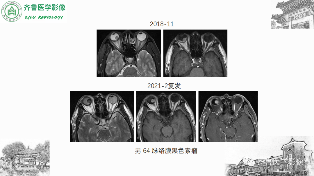 影像PPT - 【PPT】眼与眼眶病变—脉络膜黑色素瘤-23