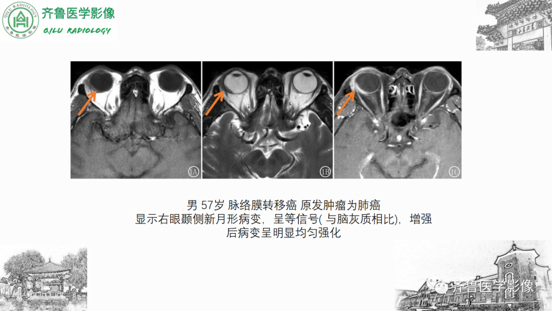 影像PPT - 【PPT】眼与眼眶病变—脉络膜黑色素瘤-27