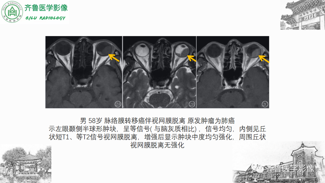 影像PPT - 【PPT】眼与眼眶病变—脉络膜黑色素瘤-28