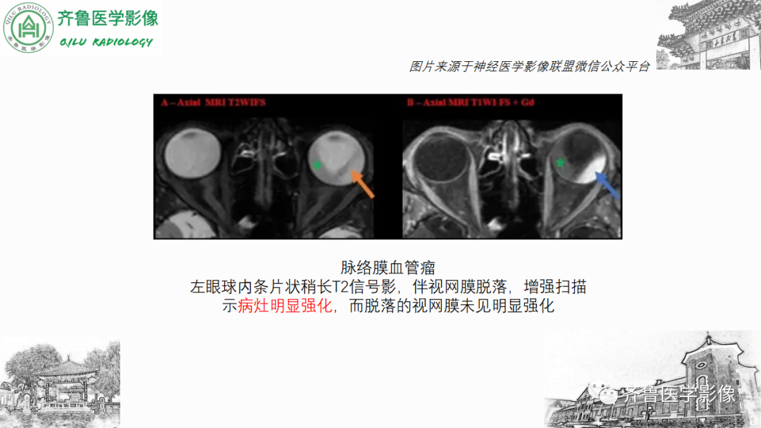 影像PPT - 【PPT】眼与眼眶病变—脉络膜黑色素瘤-30