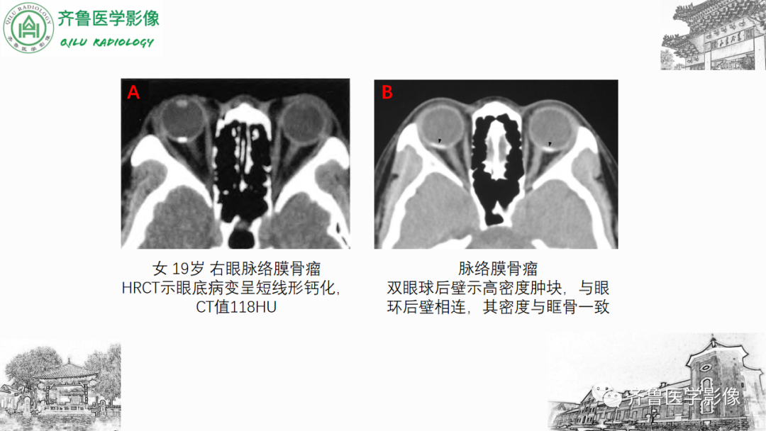 影像PPT - 【PPT】眼与眼眶病变—脉络膜黑色素瘤-32