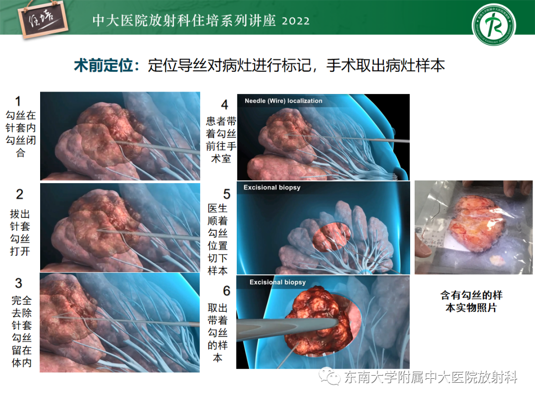 影像PPT - 【PPT】X线引导下乳腺病灶的术前定位-2