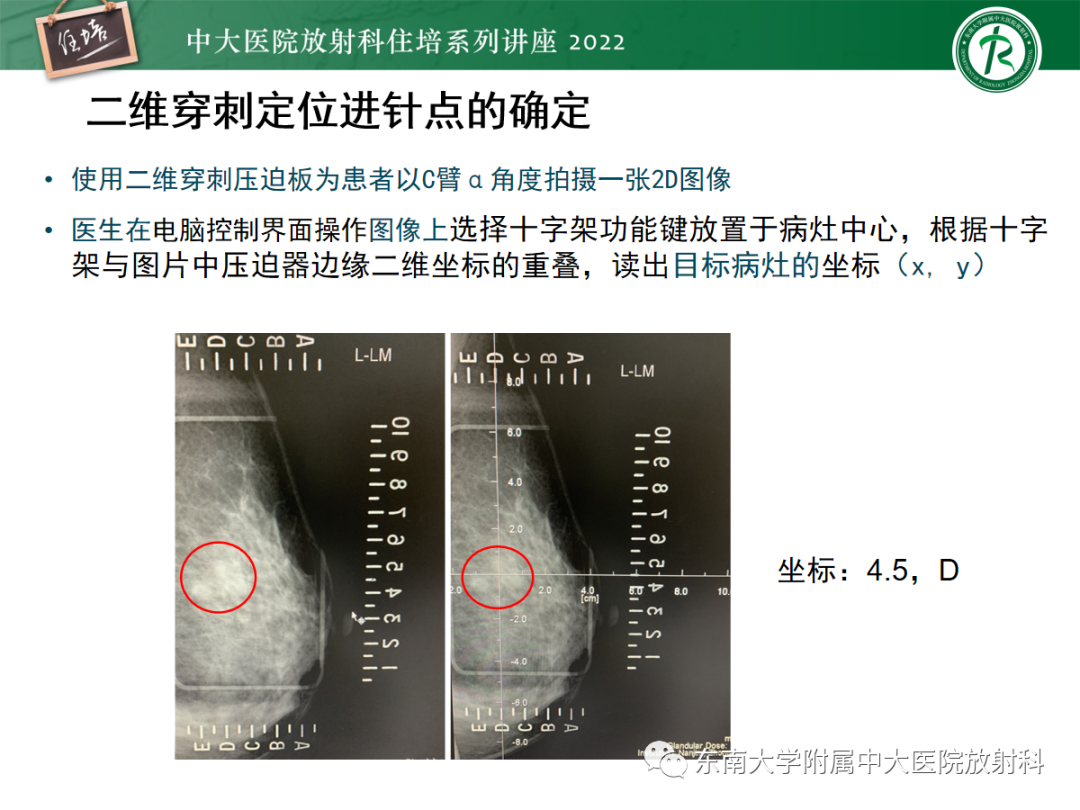 影像PPT - 【PPT】X线引导下乳腺病灶的术前定位-11