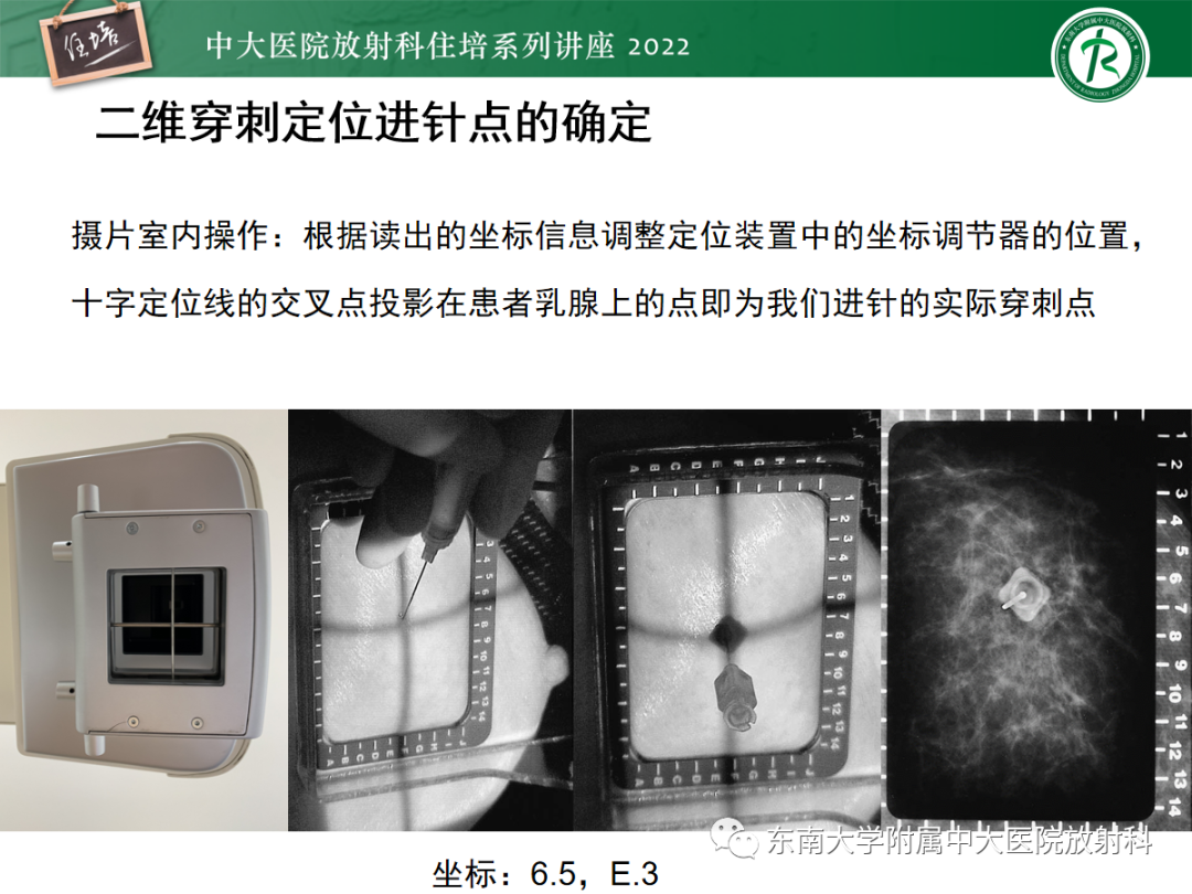 影像PPT - 【PPT】X线引导下乳腺病灶的术前定位-12