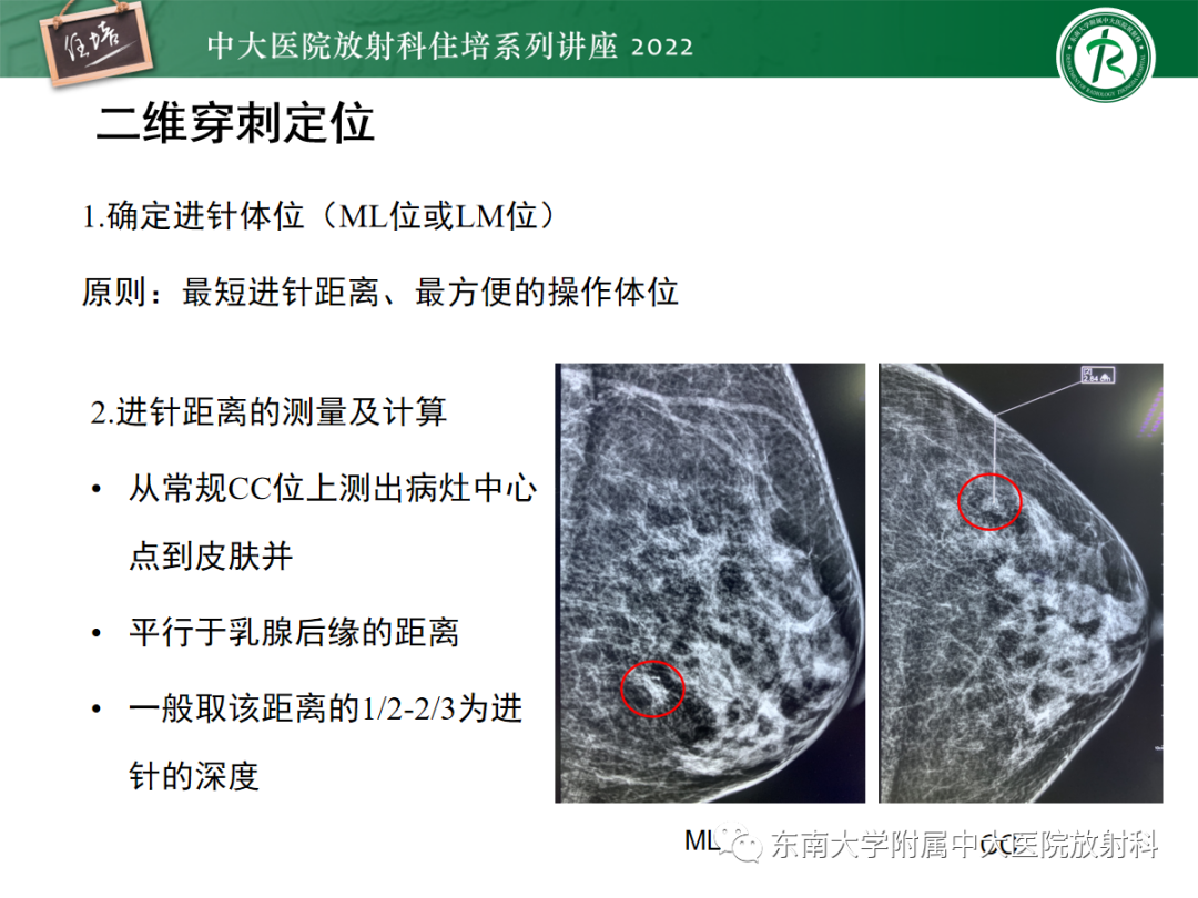 影像PPT - 【PPT】X线引导下乳腺病灶的术前定位-10