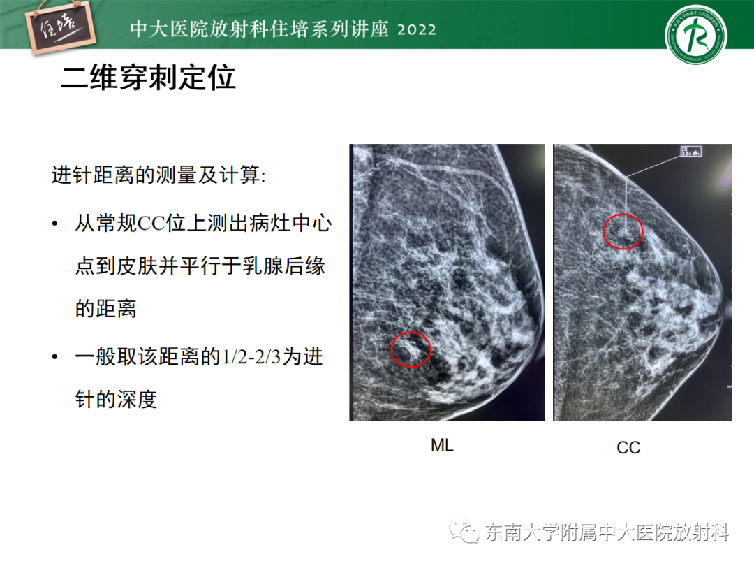 影像PPT - 【PPT】X线引导下乳腺病灶的术前定位-13