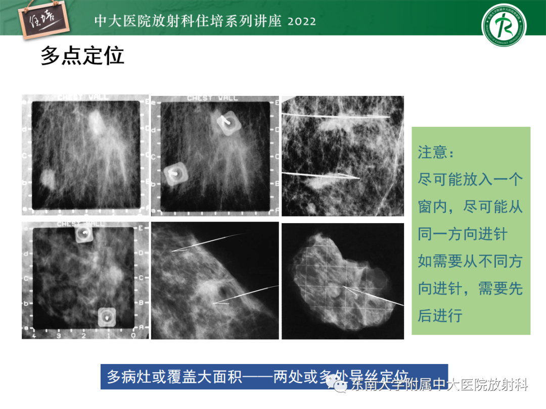 影像PPT - 【PPT】X线引导下乳腺病灶的术前定位-15