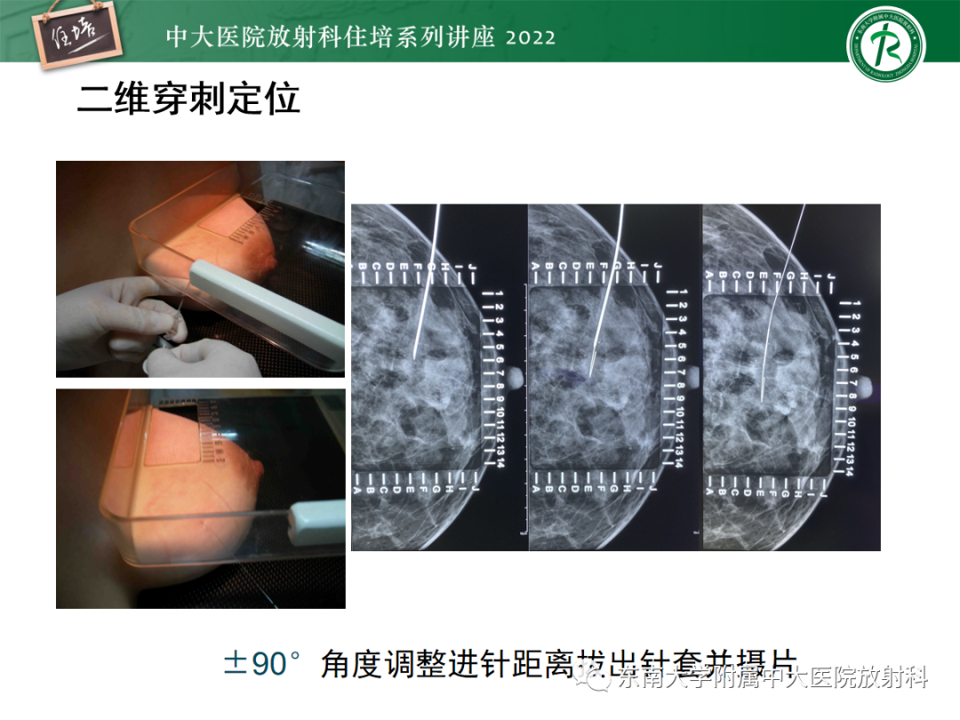 影像PPT - 【PPT】X线引导下乳腺病灶的术前定位-14