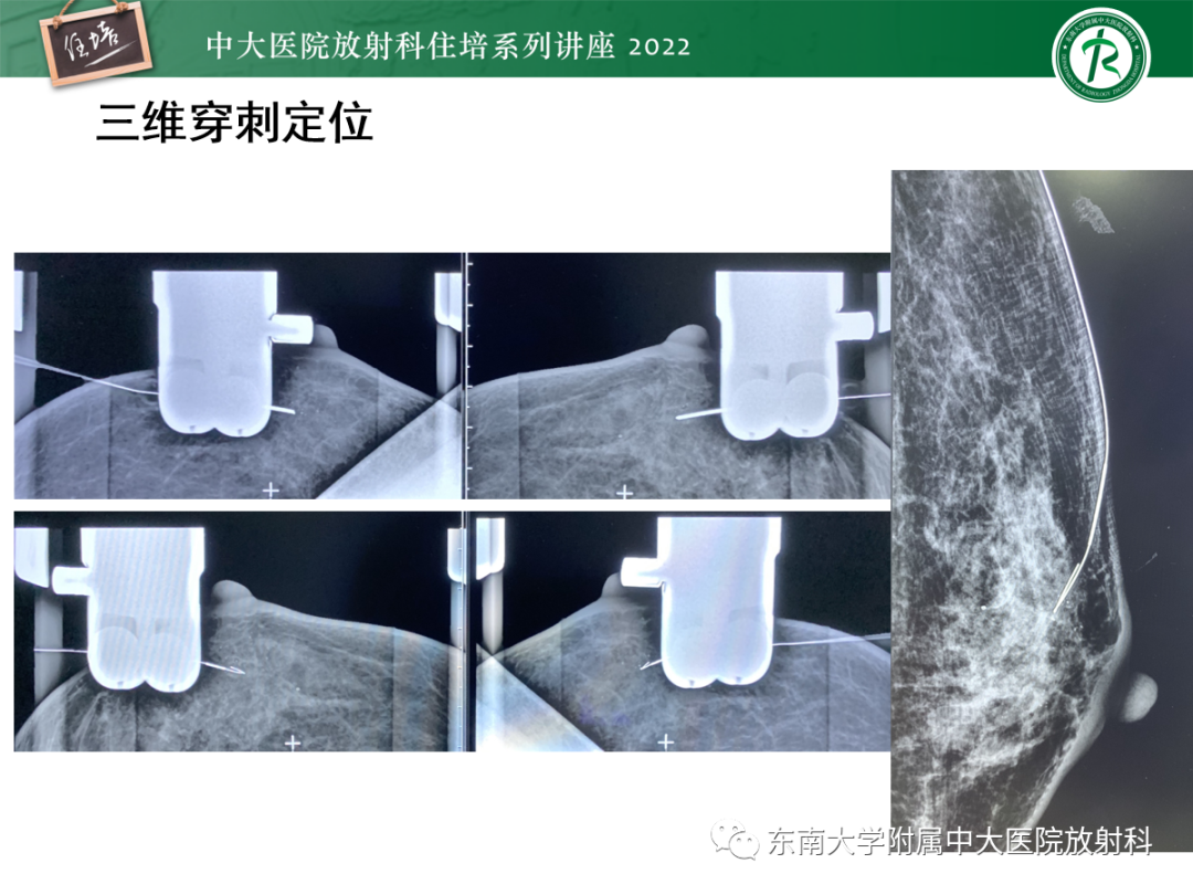 影像PPT - 【PPT】X线引导下乳腺病灶的术前定位-20