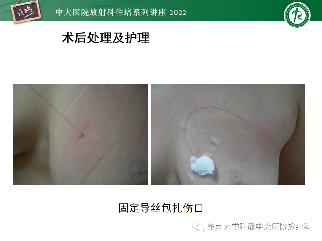 影像PPT - 【PPT】X线引导下乳腺病灶的术前定位-21