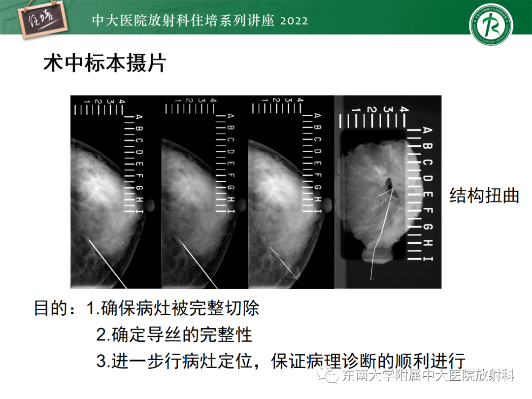影像PPT - 【PPT】X线引导下乳腺病灶的术前定位-23