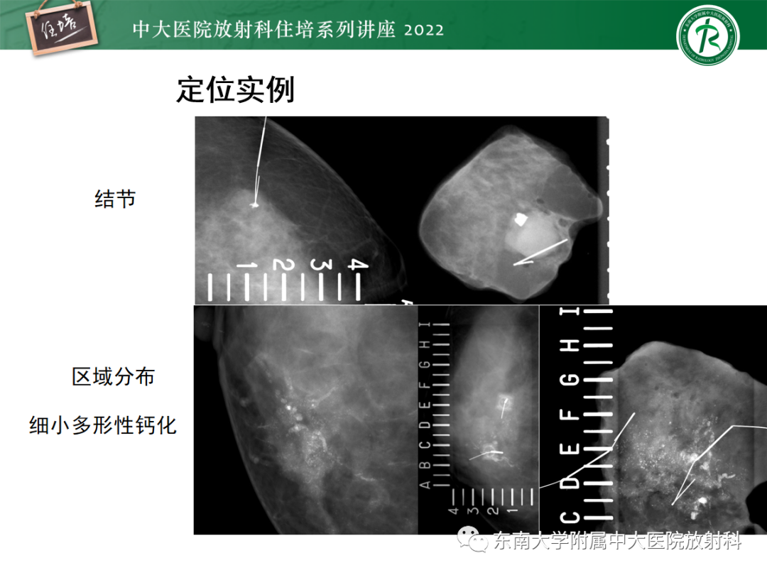 影像PPT - 【PPT】X线引导下乳腺病灶的术前定位-24