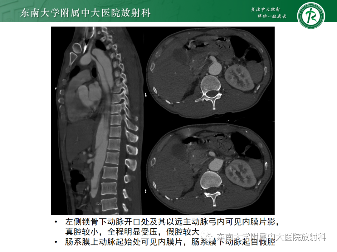 影像PPT - 【PPT】孤立性肠系膜上动脉夹层-7