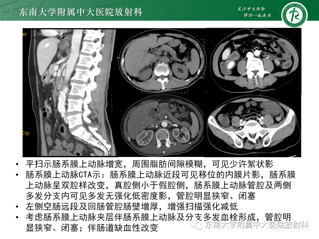 影像PPT - 【PPT】孤立性肠系膜上动脉夹层-11