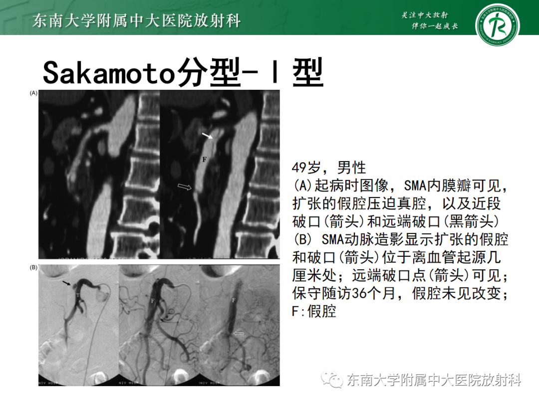 影像PPT - 【PPT】孤立性肠系膜上动脉夹层-15