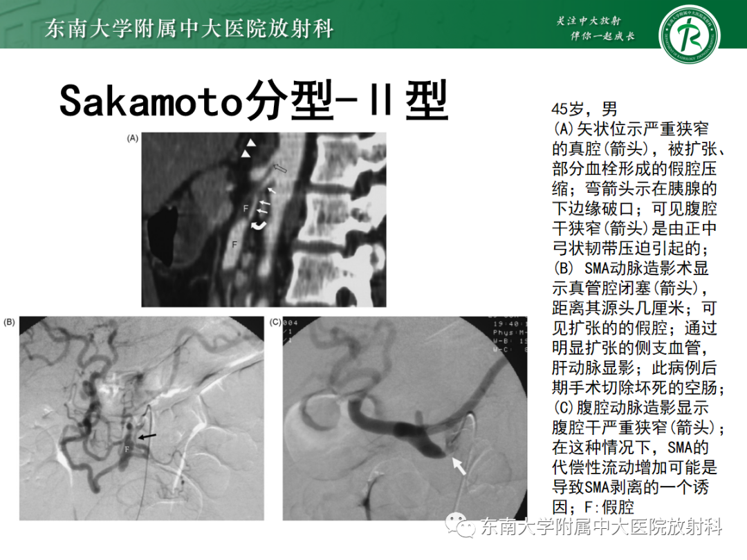 影像PPT - 【PPT】孤立性肠系膜上动脉夹层-16