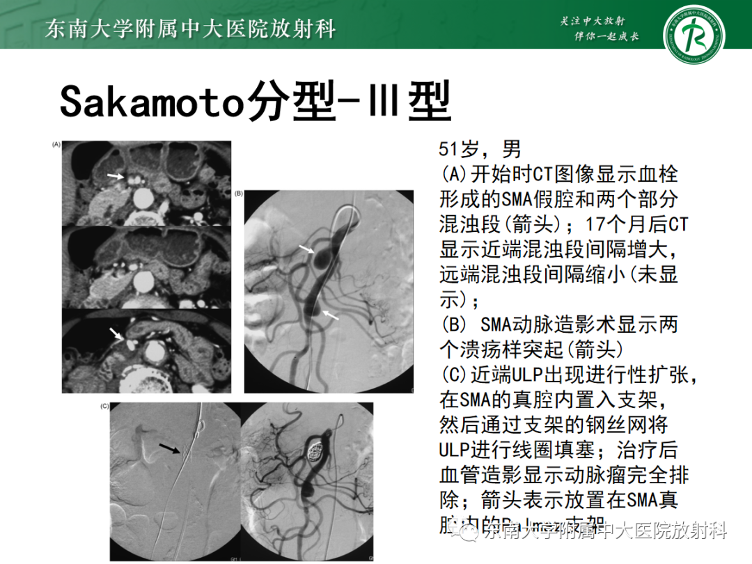 影像PPT - 【PPT】孤立性肠系膜上动脉夹层-17