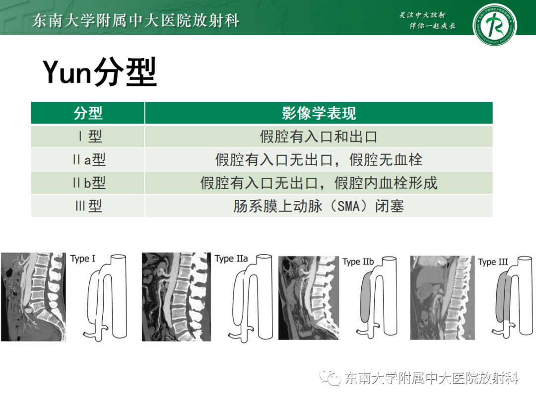 影像PPT - 【PPT】孤立性肠系膜上动脉夹层-19