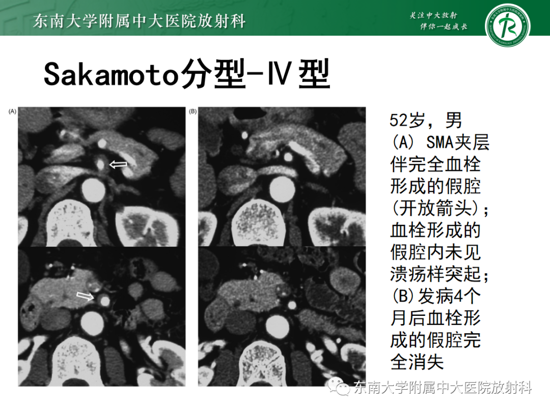 影像PPT - 【PPT】孤立性肠系膜上动脉夹层-18