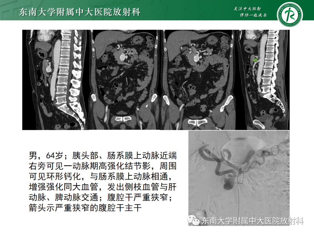 影像PPT - 【PPT】孤立性肠系膜上动脉夹层-25