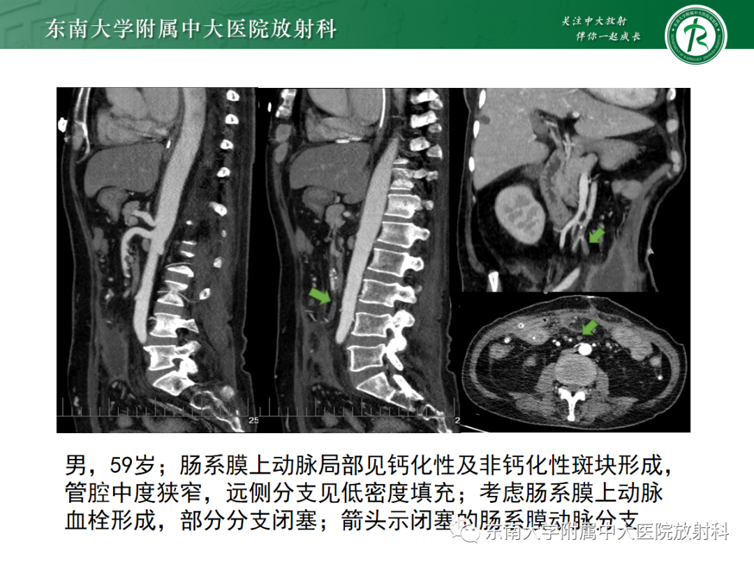 影像PPT - 【PPT】孤立性肠系膜上动脉夹层-23